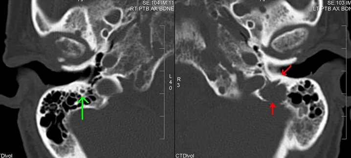 The Scan That Found Nothing Wrong — and Something Else Anyway: Life After an Incidental Finding